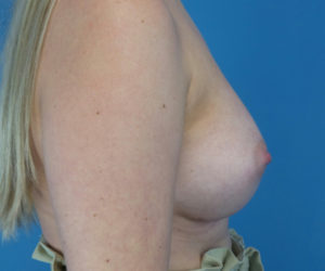 after breast augmentation right side view case 3788