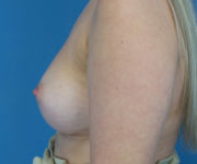 after breast augmentation left side view case 3788