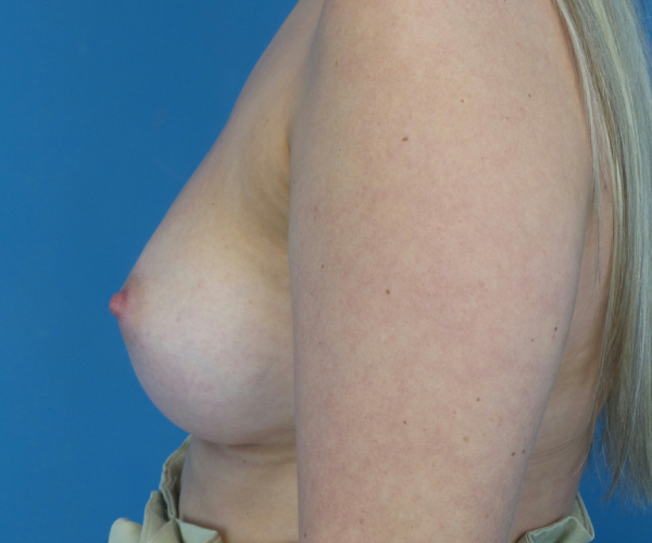 after breast augmentation left side view case 3788