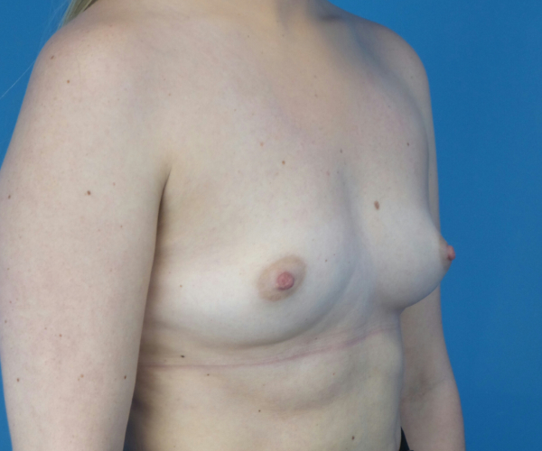 before breast augmentation right angled view case 3788