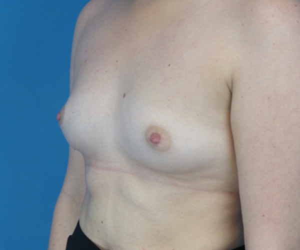 before breast augmentation left angled view case 3788