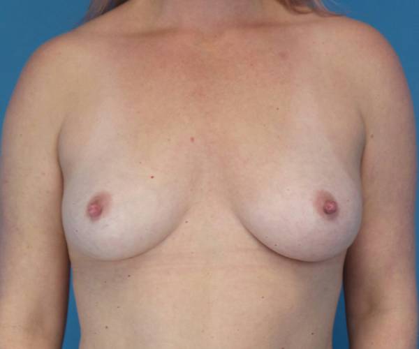 before breast augmentation front view female patient case 3797