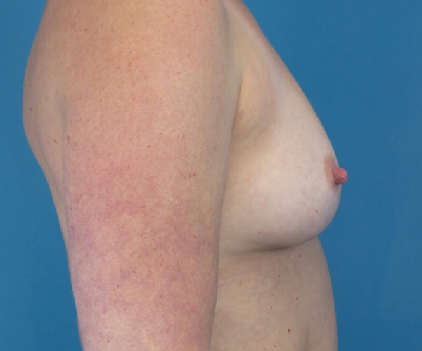 before breast augmentation right side view female patient case 3797