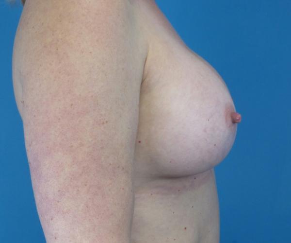 after breast augmentation right side view female patient case 3797