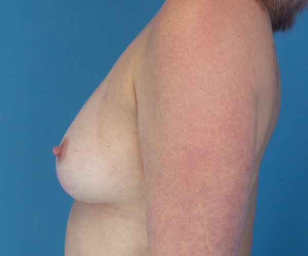before breast augmentation left side view female patient case 3797