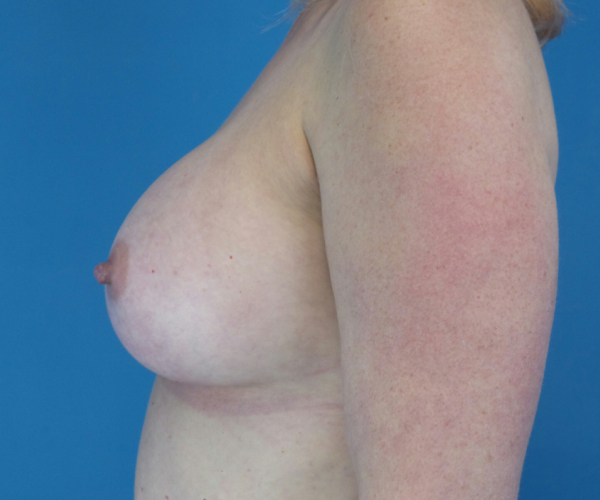 after breast augmentation left side view female patient case 3797