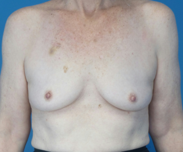 before breast augmentation front view case 3819