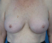 after breast augmentation front view case 3819