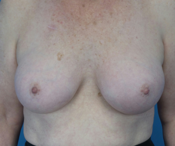 after breast augmentation front view case 3819