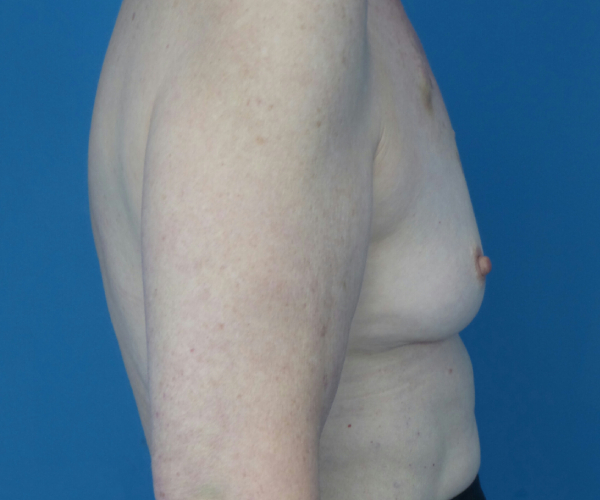 before breast augmentation right side view case 3819