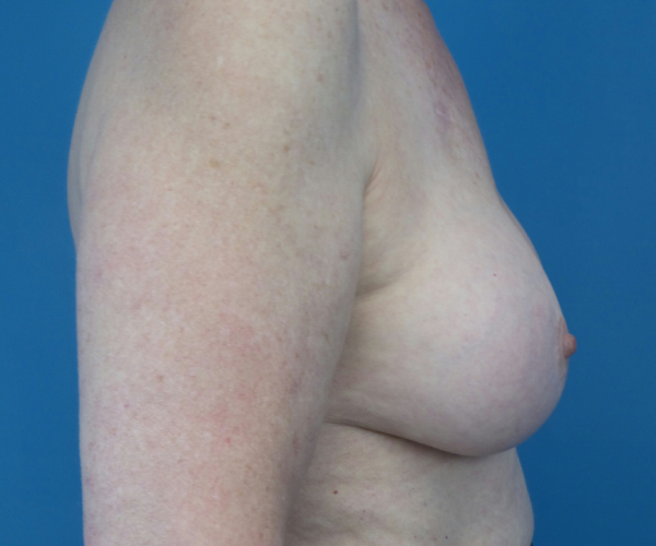 after breast augmentation right side view case 3819