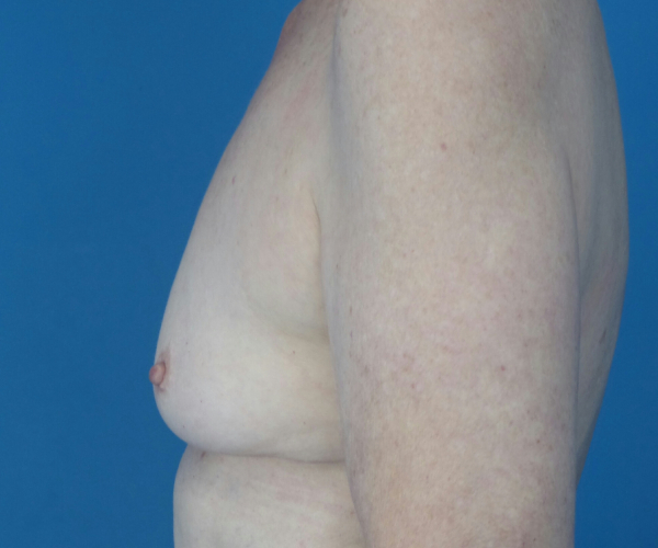 before breast augmentation left side view case 3819