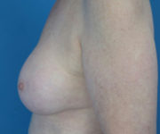 after breast augmentation left side view case 3819
