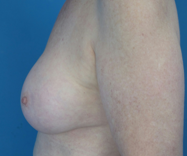 after breast augmentation left side view case 3819