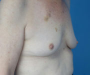 before breast augmentation right angled view case 3819