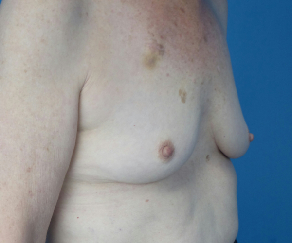 before breast augmentation right angled view case 3819