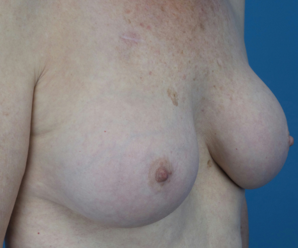 after breast augmentation right angled view case 3819