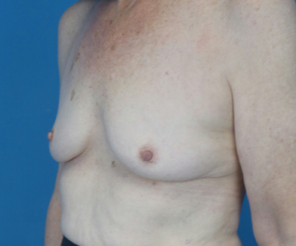 before breast augmentation left angled view case 3819