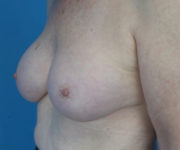 after breast augmentation left angled view case 3819