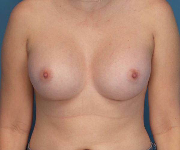 after breast augmentation front view case 3830