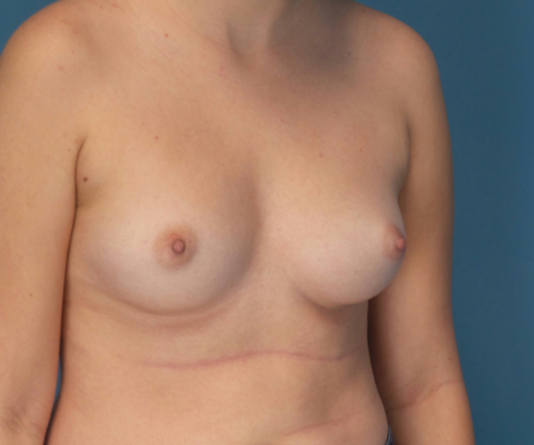 before breast augmentation right angled view case 3830
