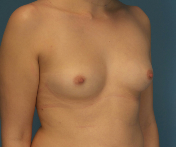 before breast augmentation right angled view case 3841