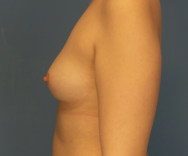 before breast augmentation left side view case 3841