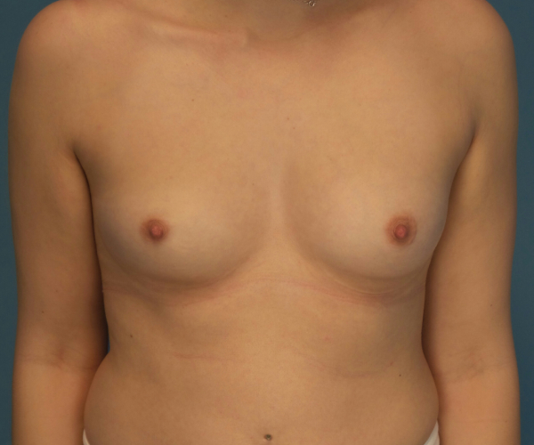 before breast augmentation front view case 3841