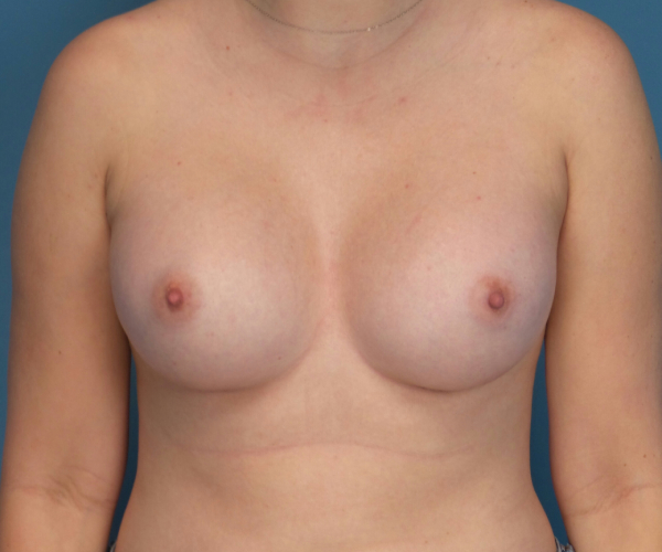 after breast augmentation front view case 3841