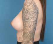 after breast augmentation left side view case 3851