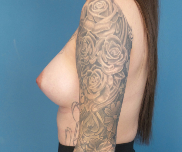after breast augmentation left side view case 3851