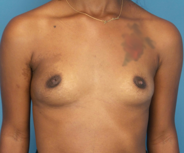 before breast augmentation front view case 3766 | Crispin Plastic Surgery Atlanta, GA