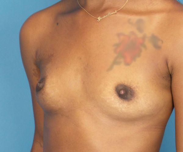 before breast augmentation left diagonal view case 3766 | Crispin Plastic Surgery Atlanta, GA