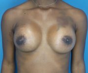 after breast augmentation front view case 3766 | Crispin Plastic Surgery Atlanta, GA
