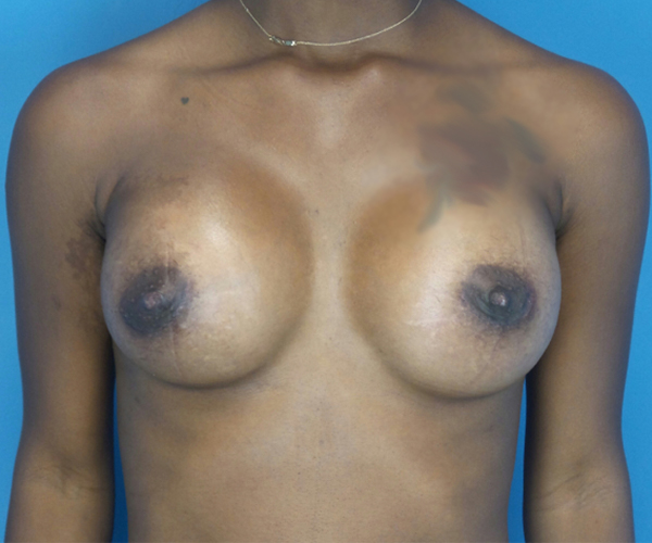 after breast augmentation front view case 3766 | Crispin Plastic Surgery Atlanta, GA