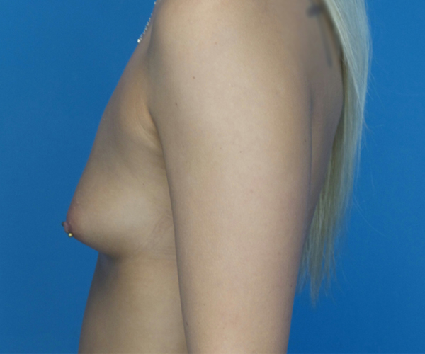before breast augmentation left view case 3009 | Crispin Plastic Surgery Atlanta, GA