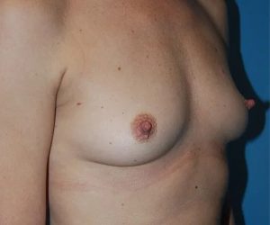 before breast augmentation front right diagonal view case 4567 | Crispin Plastic Surgery Atlanta, GA