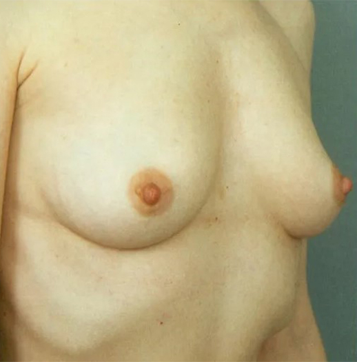 before breast augmentation front right diagonal view case 4591 | Crispin Plastic Surgery Atlanta, GA