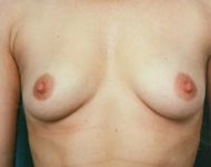 before breast augmentation front view case 4594 | Crispin Plastic Surgery Atlanta, GA