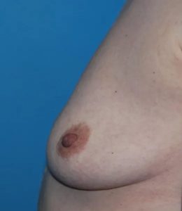 before breast augmentation left side view case 4602 | Crispin Plastic Surgery Atlanta, GA