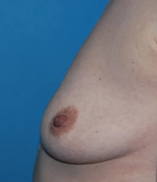 before breast augmentation left side view case 4602 | Crispin Plastic Surgery Atlanta, GA