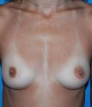 before breast augmentation front view case 4608 | Crispin Plastic Surgery Atlanta, GA