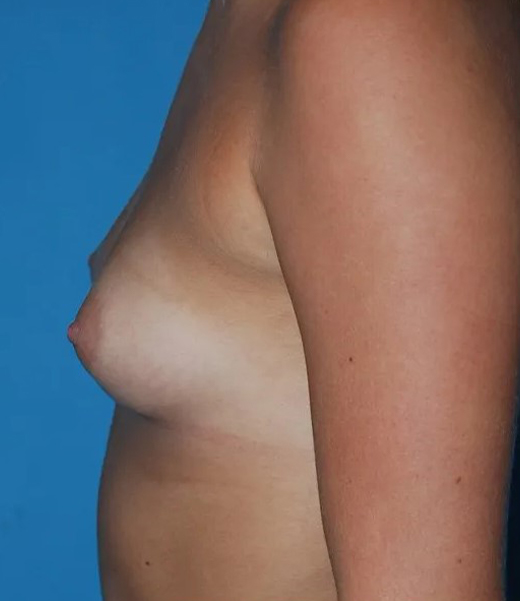 before breast augmentation left side view case 4615 | Crispin Plastic Surgery Atlanta, GA
