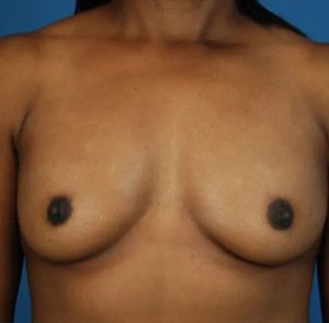before breast augmentation front view case 4625 | Crispin Plastic Surgery Atlanta, GA