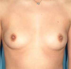 before breast augmentation front view case 4628 | Crispin Plastic Surgery Atlanta, GA