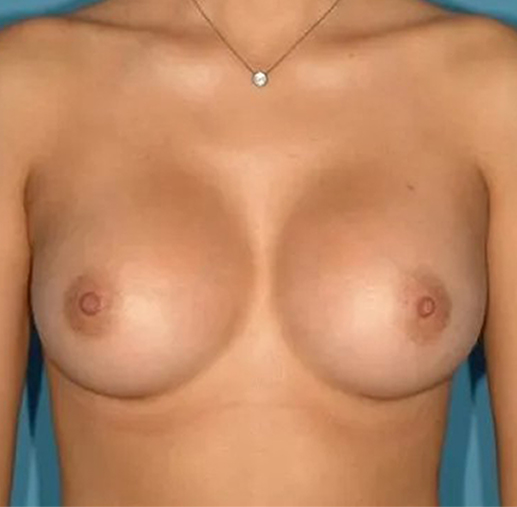after breast augmentation front view case 4628 | Crispin Plastic Surgery Atlanta, GA