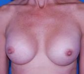 after breast augmentation front view case 4638 | Crispin Plastic Surgery Atlanta, GA