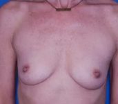 before breast augmentation front view case 4638 | Crispin Plastic Surgery Atlanta, GA