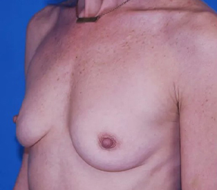 before breast augmentation front left diagonal view case 4638 | Crispin Plastic Surgery Atlanta, GA