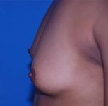 before breast augmentation left side view case 4646 | Crispin Plastic Surgery Atlanta, GA